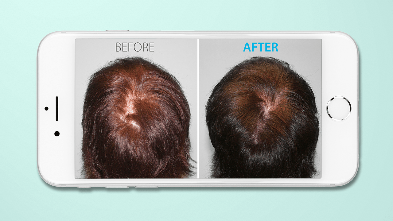 hair loss before and after photos