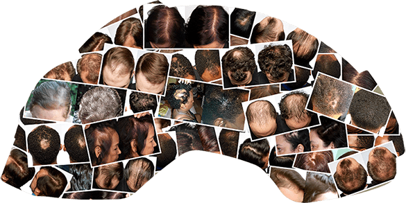 laser hair growth