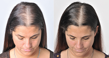 Theradome before and after user 1