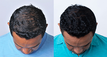 Theradome before and after user 3