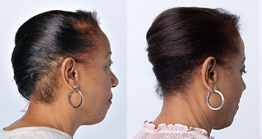 Theradome before and after user 4