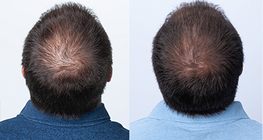 Theradome before and after user 9