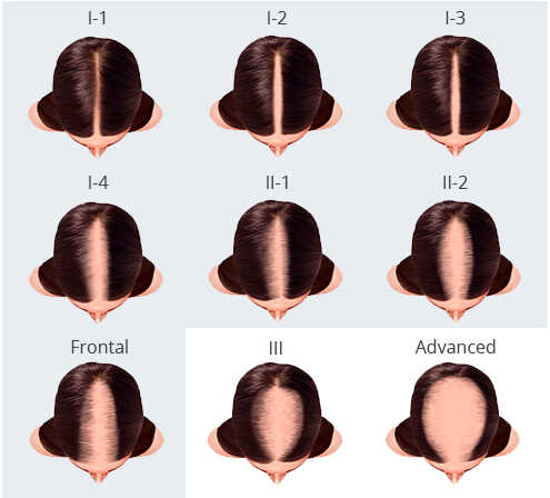 Female Hair Loss Classification