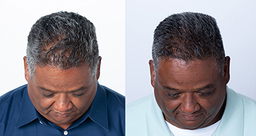 Theradome before and after user 10