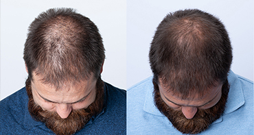 hair loss and dht