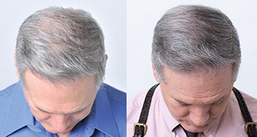 Theradome before and after user 5