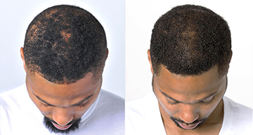 Theradome before and after user 2