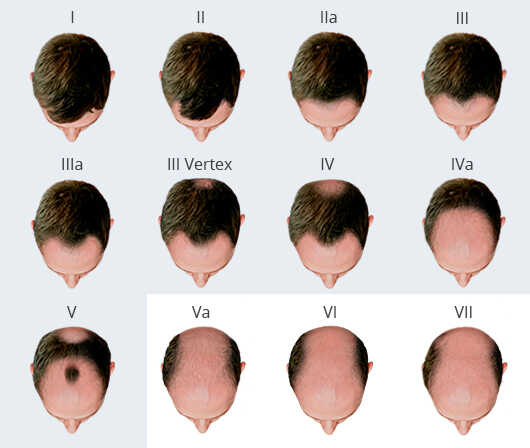 Male Hair Loss Classification