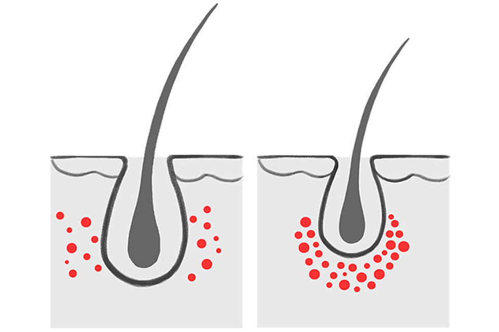 laser phototherapy