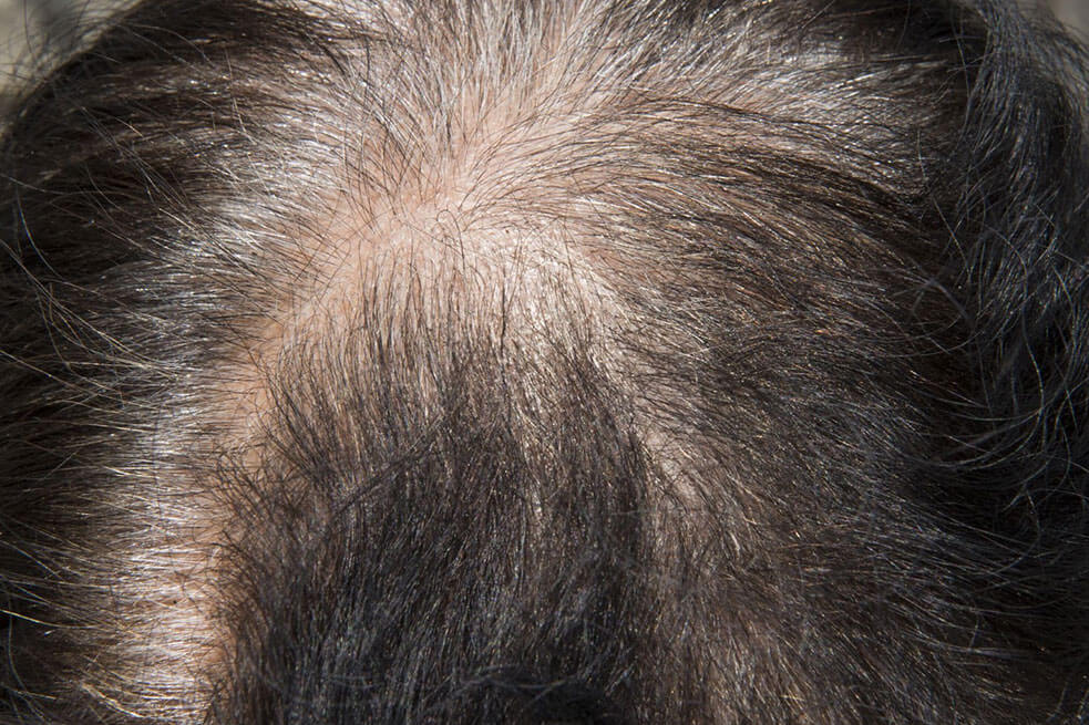 Hair Loss