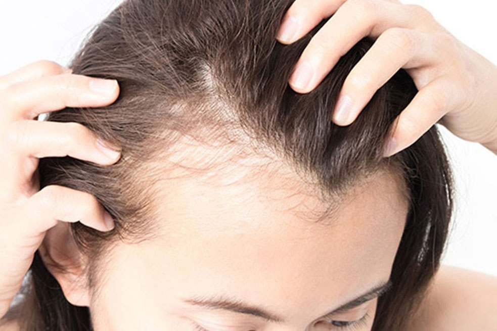 Is Hair Loss Reversible