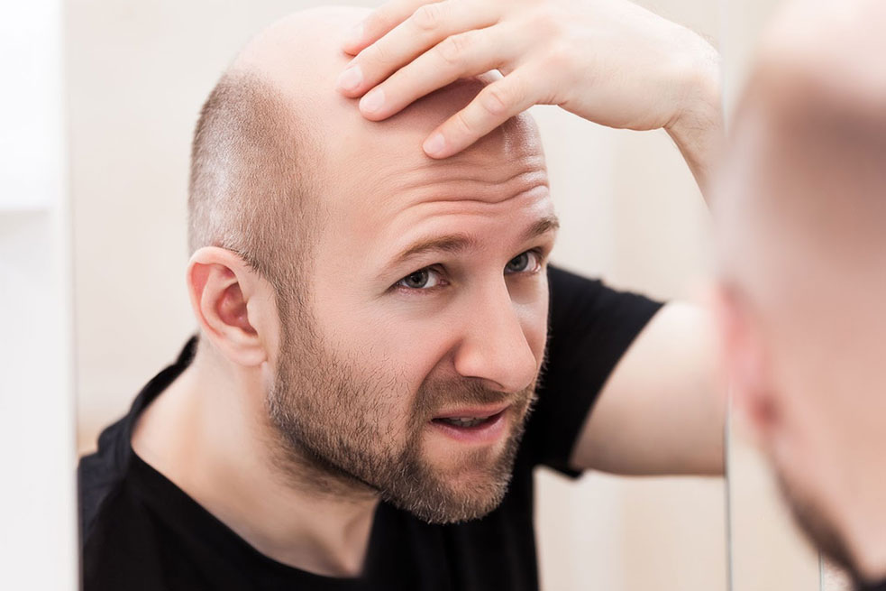 Mens Hair Loss