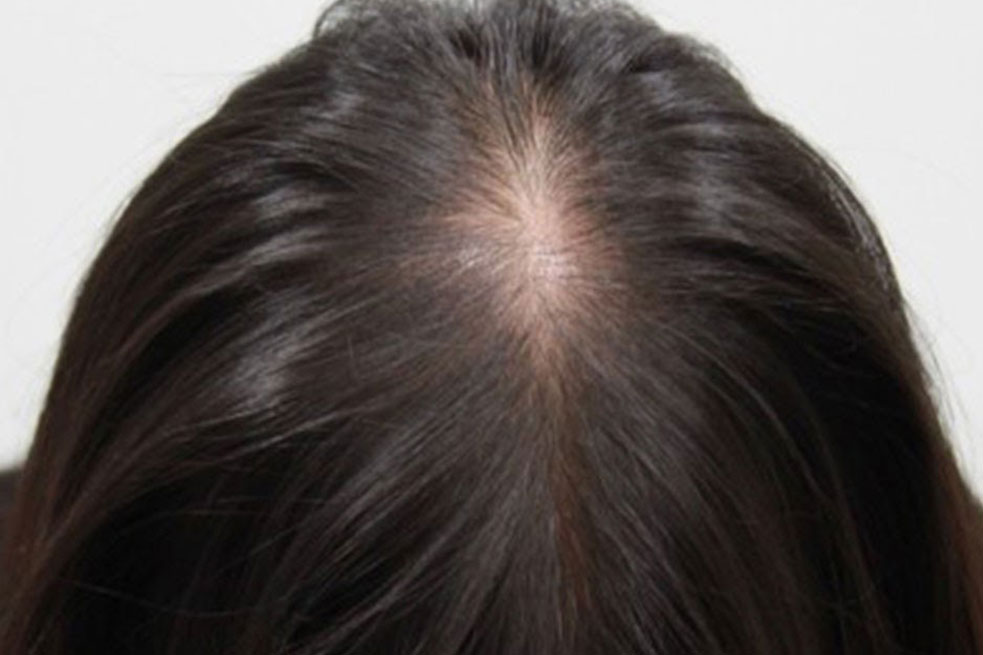 Patches of Hair Loss