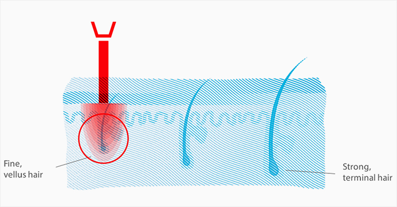 Hair Loss Reversible