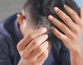 Scalp inflammation and hair loss